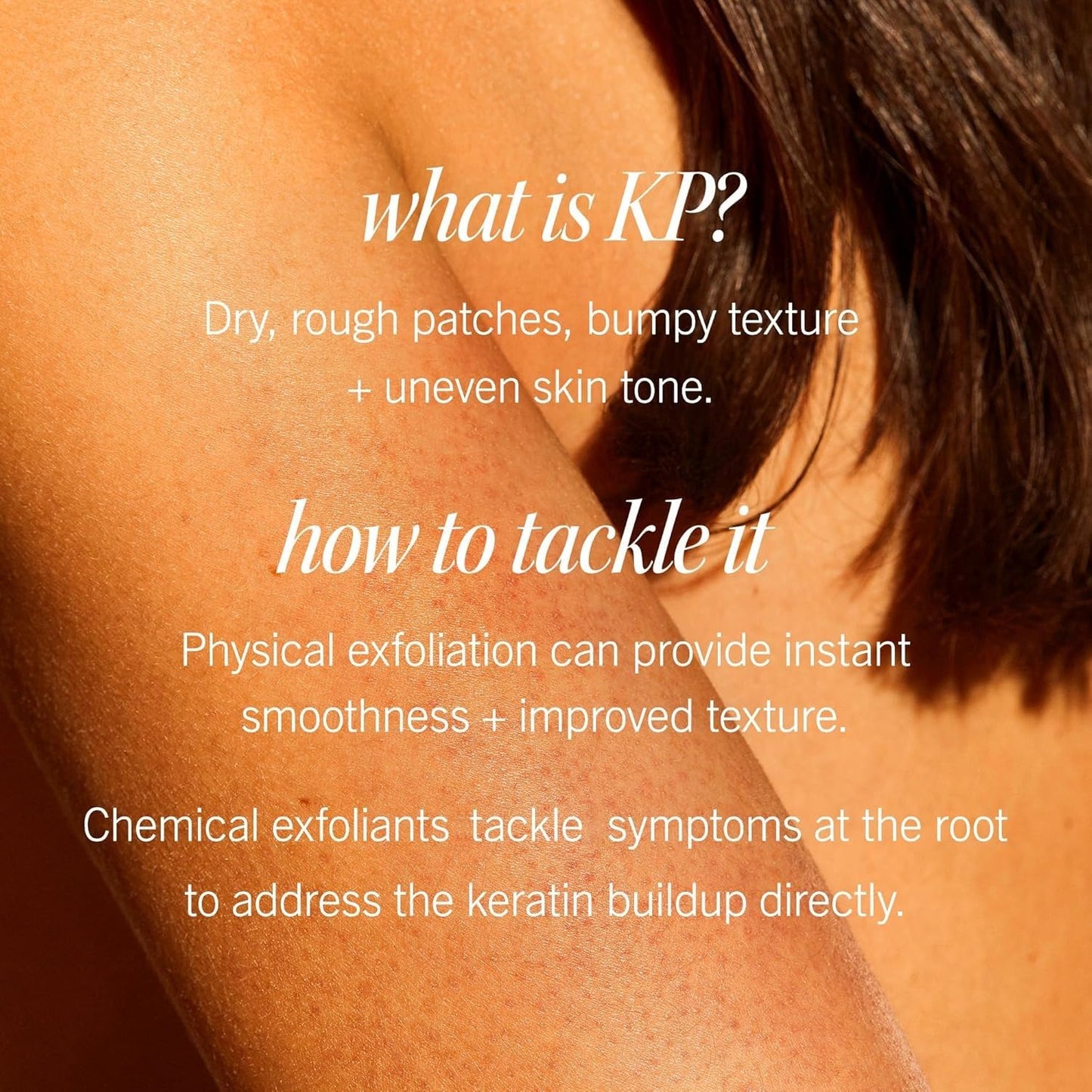 First Aid Beauty - KP Bump Eraser Body Scrub with 10% AHA, Keratosis Pilaris Skin Exfoliater with Glycolic and Lactic acids, Helps Reduce Chicken Skin Bumps, Safe for Sensitive Skin, 8 oz, 2ct